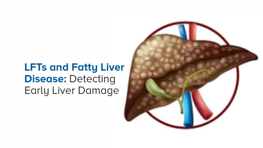 LFTs and Fatty Liver Disease: Detecting Early Liver Damage